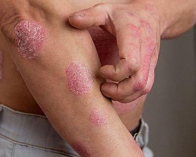 SRIMAYAM AYURVED - Psoriasis treatment Surat, Gujarat — Hospitals in Surat